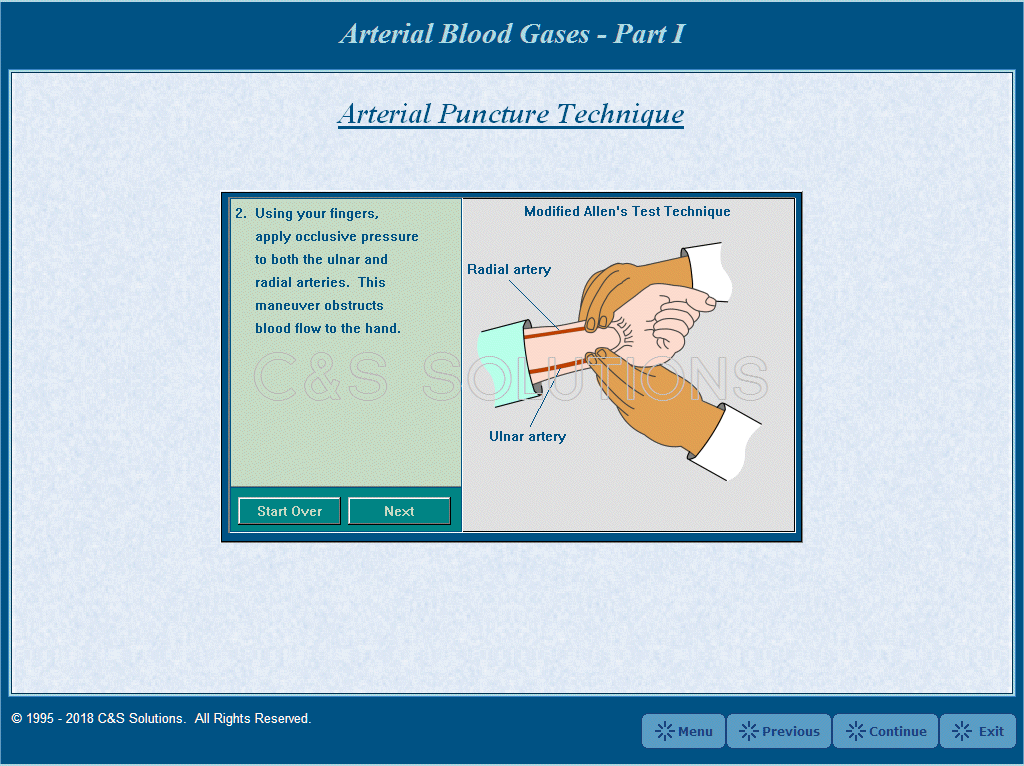 Arterial Blood Gases Part I: Blood Gas Sampling and Interpretation Modified Allen's Test