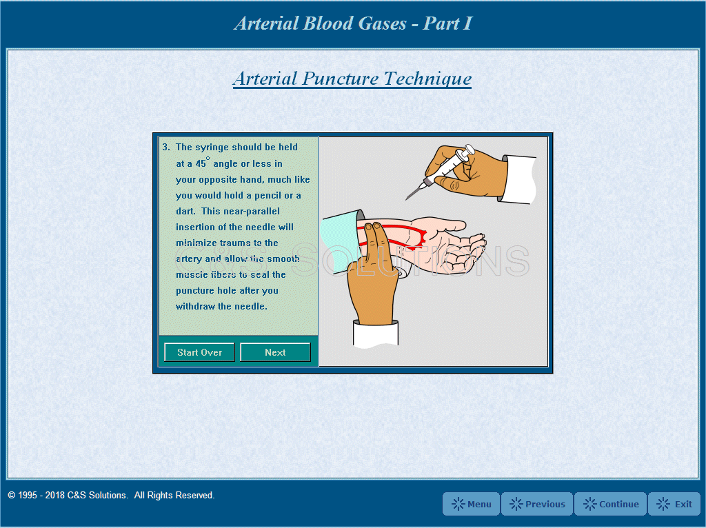 Arterial Blood Gases Part I: Blood Gas Sampling and Interpretation Arterial Puncture Technique