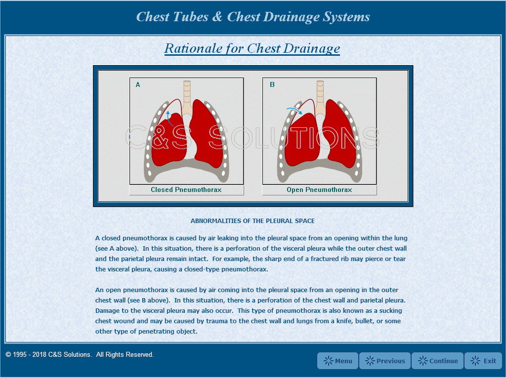 Chest Tubes and Chest Drainage Systems Closed / Open Pneumothorax