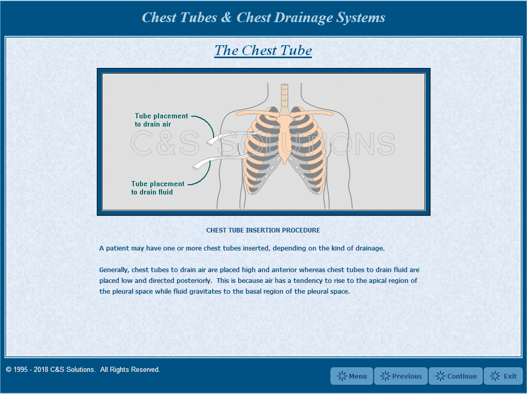 Chest Tubes and Chest Drainage Systems Chest Tube Positioning