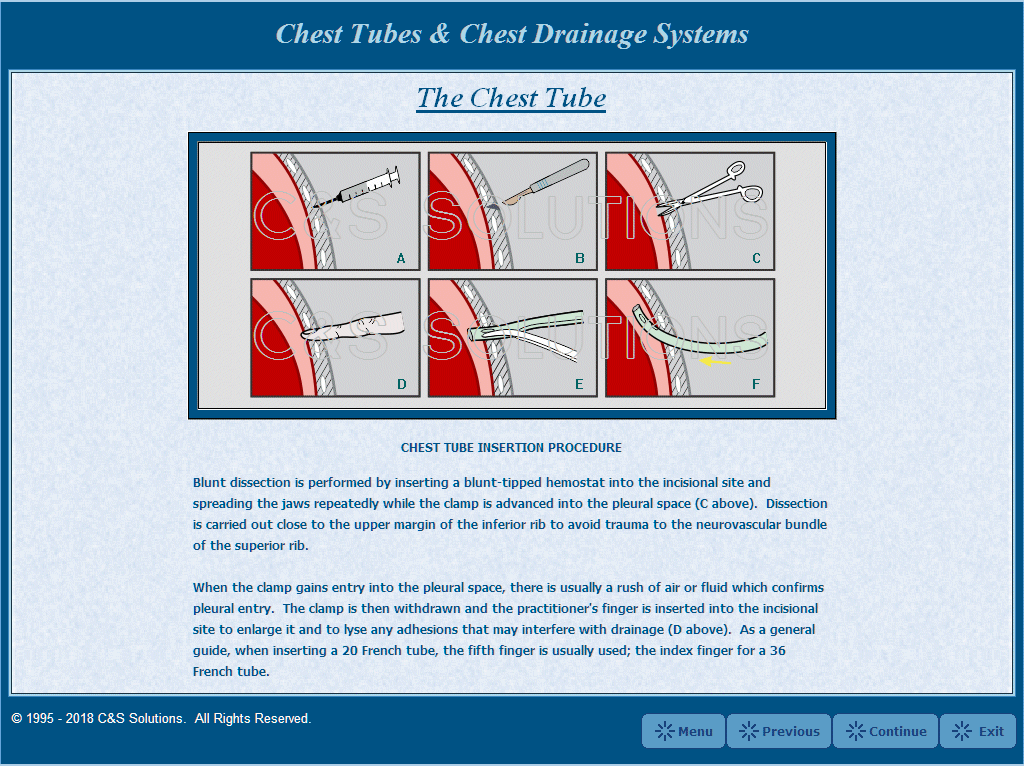 Chest Tubes and Chest Drainage Systems Chest Tube Insertion