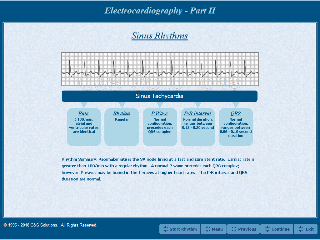 Electrocardiography Part II: Basic Arrhythmia Recognition Sinus Tachycardia