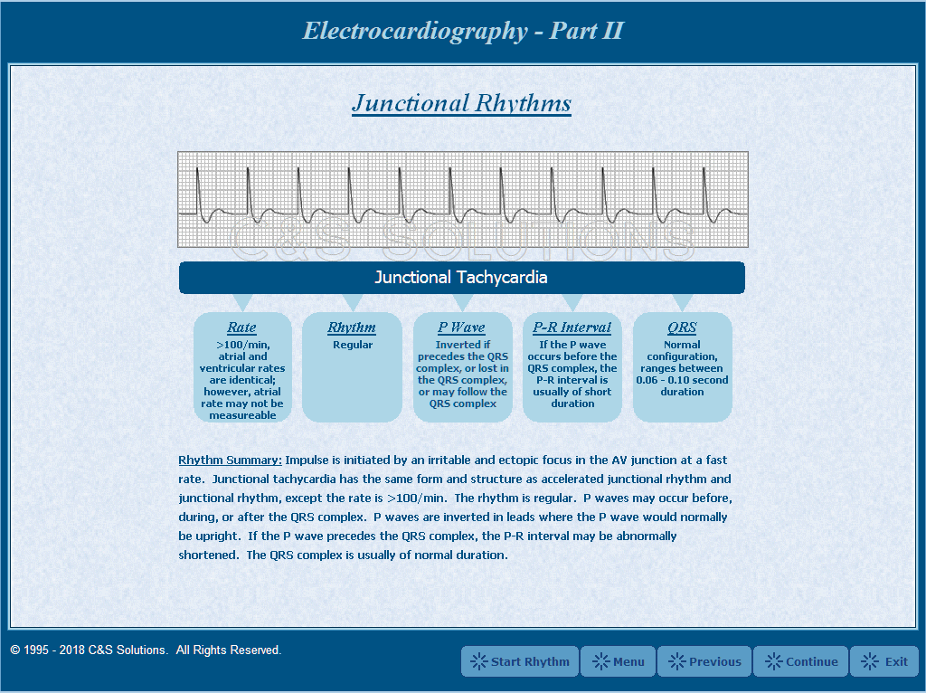 Electrocardiography Part II: Basic Arrhythmia Recognition Junctional Tachycardia