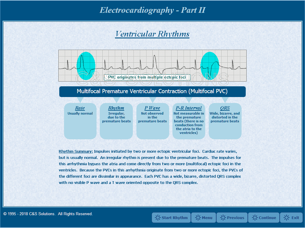 Electrocardiography Part II: Basic Arrhythmia Recognition Multifocal PVC