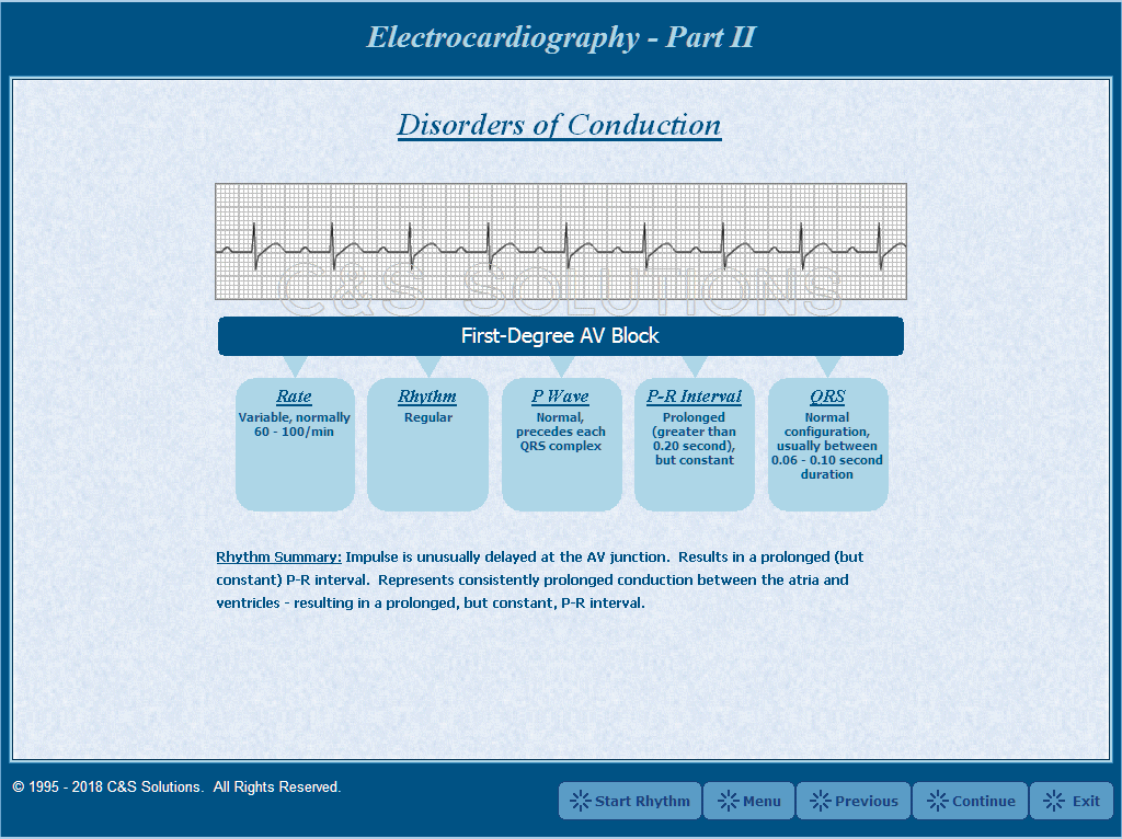 Electrocardiography Part II: Basic Arrhythmia Recognition First-Degree AV Block