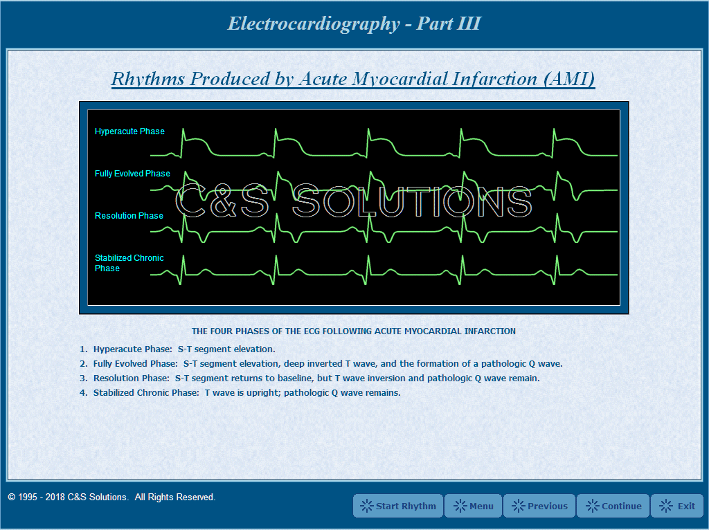 Electrocardiography Part III: Advanced Arrhythmia Recognition Acute Myocardial Infarction