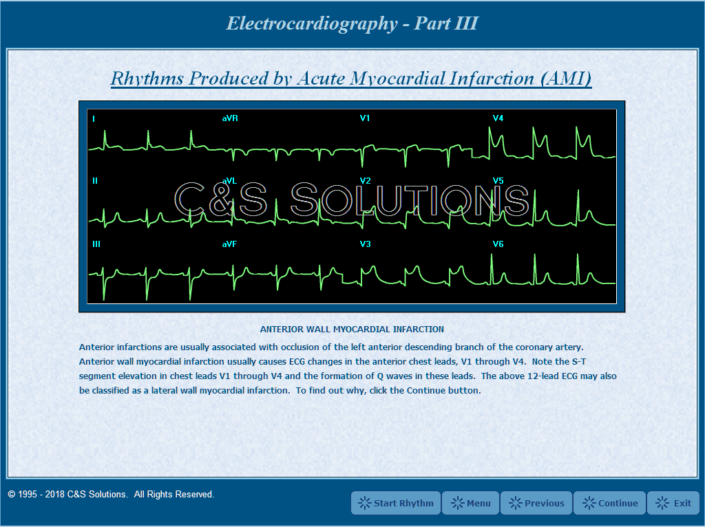Electrocardiography Part III: Advanced Arrhythmia Recognition Anterior Wall Myocardial Infarction