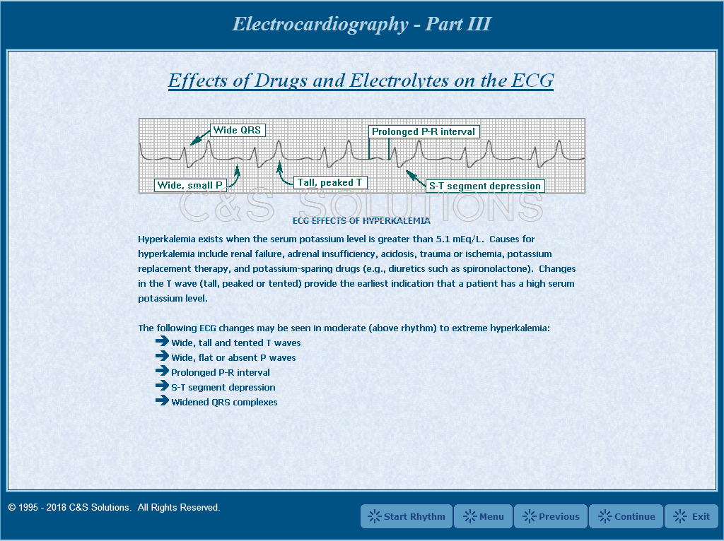 Electrocardiography Part III: Advanced Arrhythmia Recognition ECG Effects of Hyperkalemia